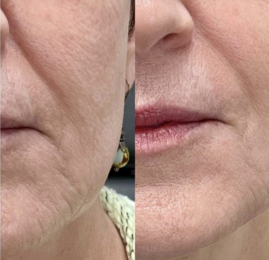 Before and after skin rejuvenation treatment showing improved skin texture.